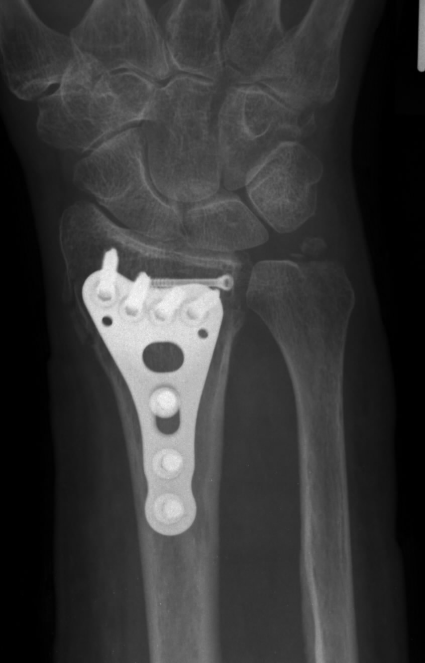 Heidemann - Hand- und Ellenbogenchirurgie in Hürth - Knochenbruchbehandlung